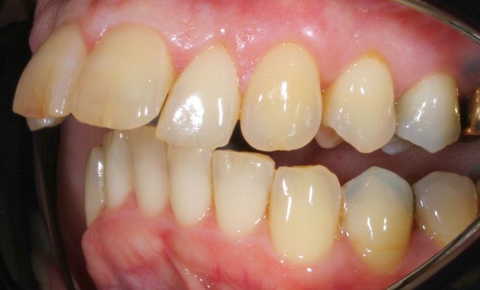 Before - Gibside Dental