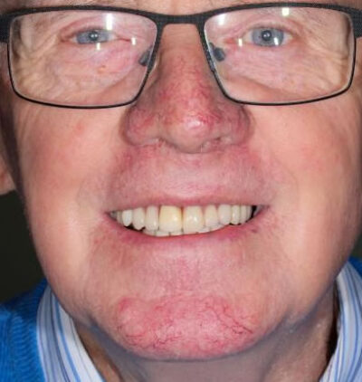 Smile Gallery - Gibside Dental