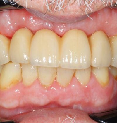 Smile Gallery - Gibside Dental