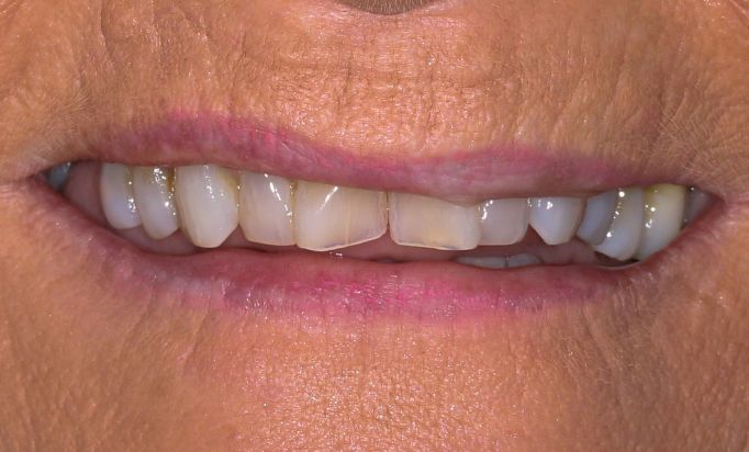 Before - Gibside Dental