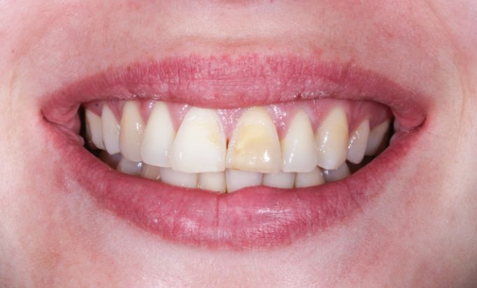 Before - Gibside Dental