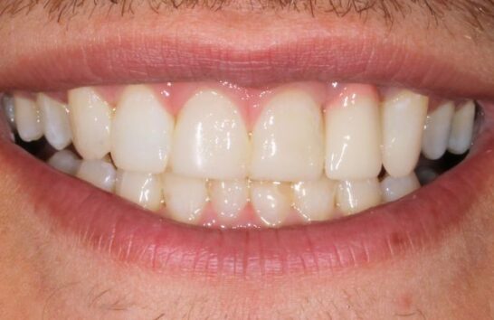 After - Invisalign