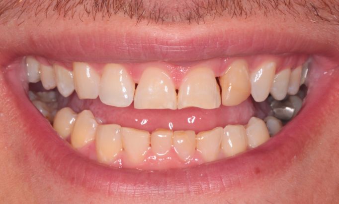 Before - Gibside Dental