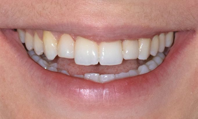 After -Gibside Dental