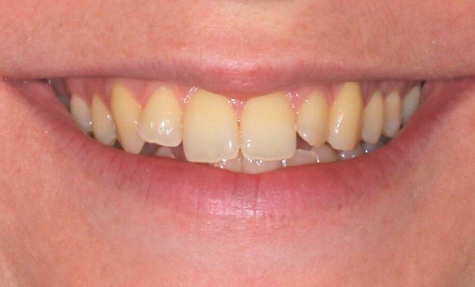 Before - Gibside Dental