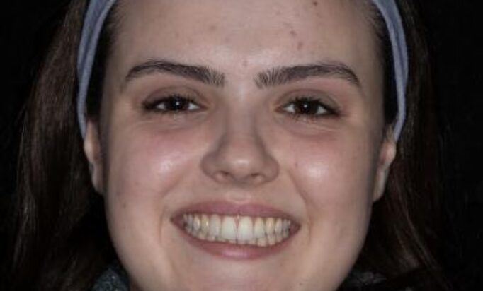 Smile Gallery -Gibside Dental