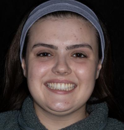 Smile Gallery - Gibside Dental