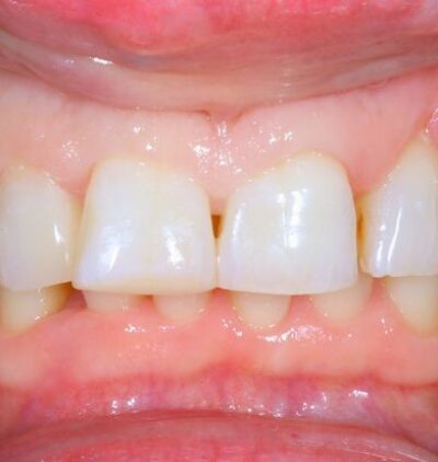 Smile Gallery - Gibside Dental