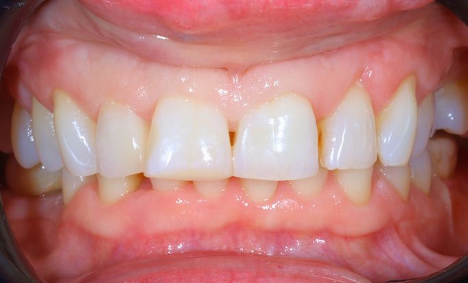 After -Gibside Dental