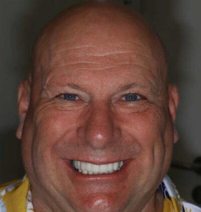 Smile Gallery - Gibside Dental