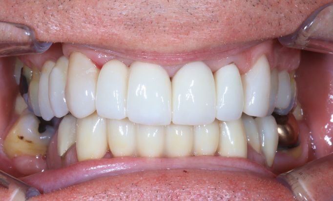 After -Gibside Dental