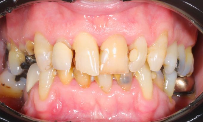 Before - Gibside Dental