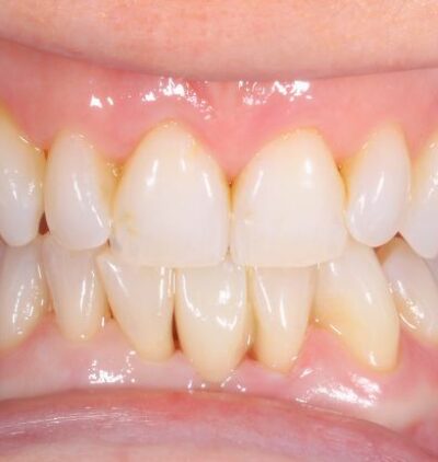 Smile Gallery - Gibside Dental