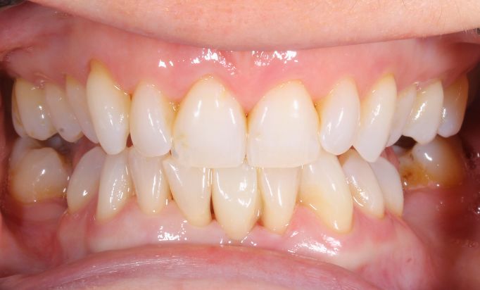 Smile Gallery -Gibside Dental