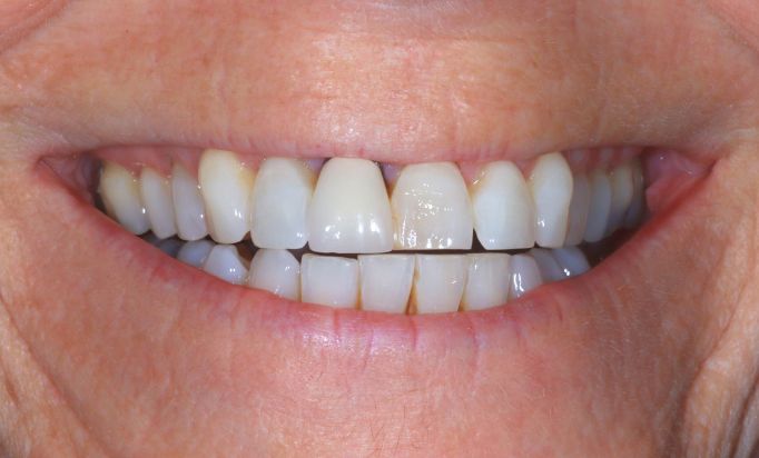 Before - Gibside Dental