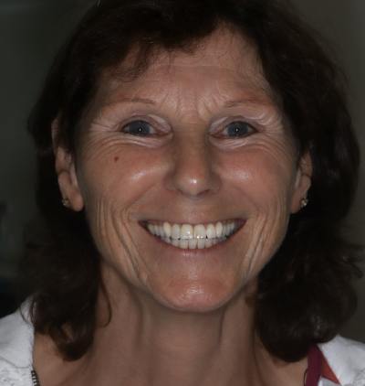 Smile Gallery - Gibside Dental