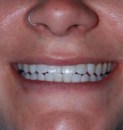 Smile Gallery - Gibside Dental