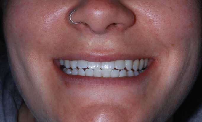 Smile Gallery -Gibside Dental