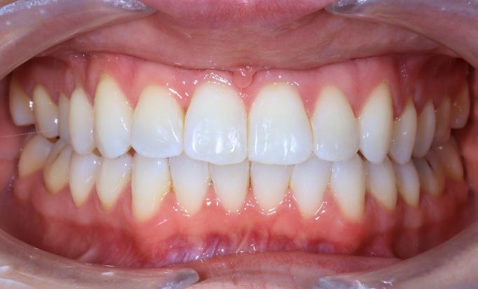 After -Gibside Dental