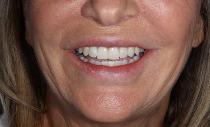 Smile Gallery -Gibside Dental