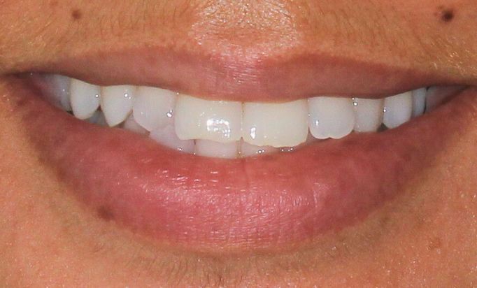 Before - Gibside Dental