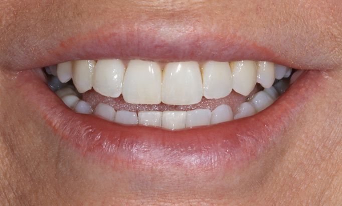 After -Gibside Dental