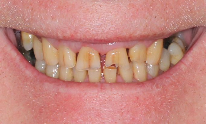 Before - Gibside Dental