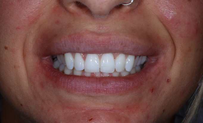 Smile Gallery -Gibside Dental