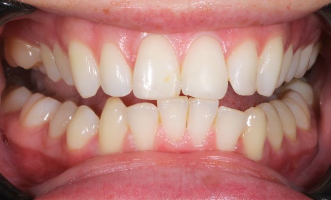 Before - Gibside Dental