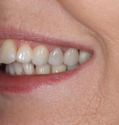 Smile Gallery - Gibside Dental