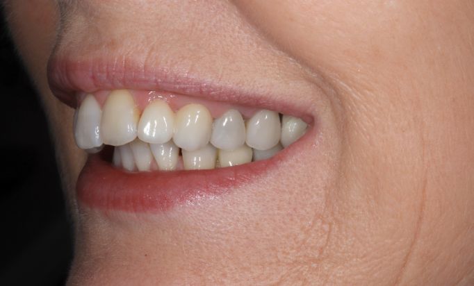 Smile Gallery -Gibside Dental