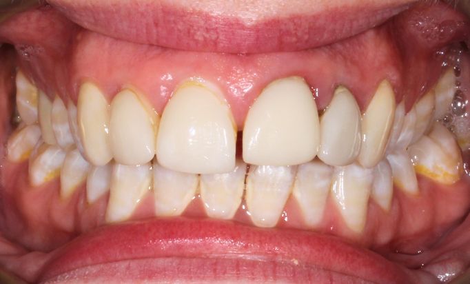 Before - Gibside Dental