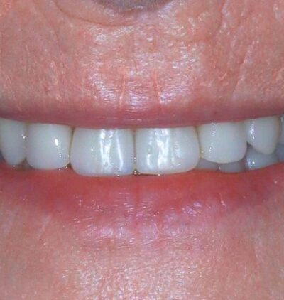 Smile Gallery - Gibside Dental