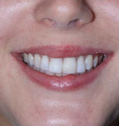 Smile Gallery - Gibside Dental