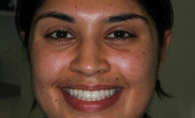 Smile Gallery -Gibside Dental