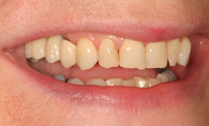 After - Gibside Dental