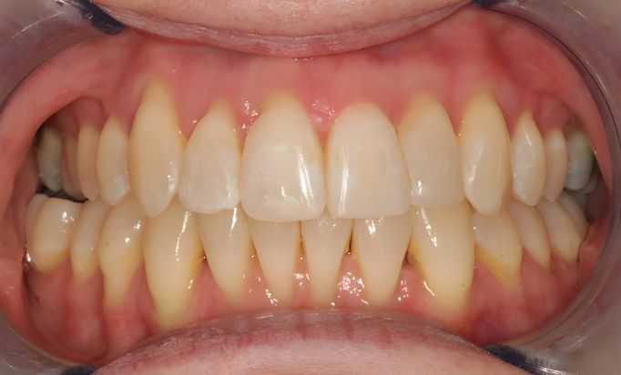 After -Gibside Dental