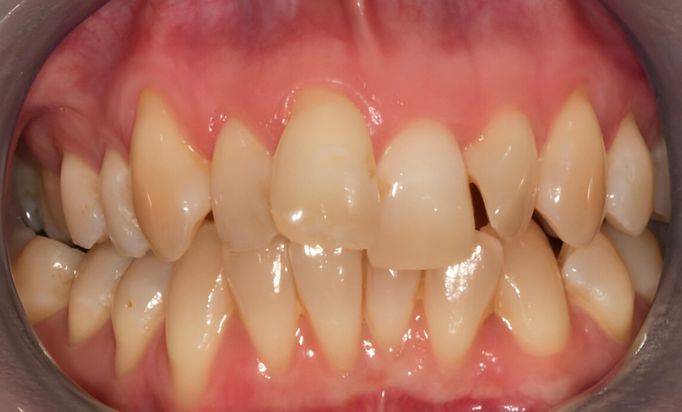 Before - Gibside Dental