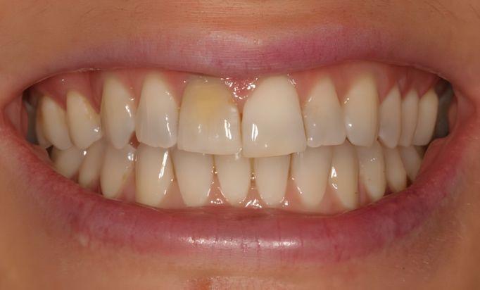 Before - Gibside Dental