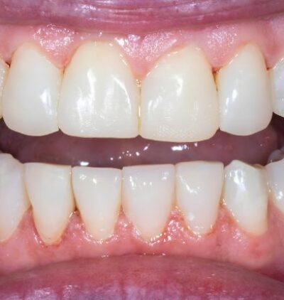 Smile Gallery - Gibside Dental