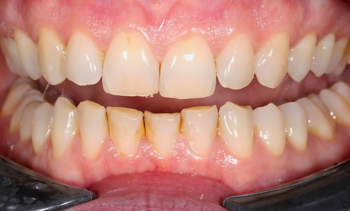 Before - Gibside Dental