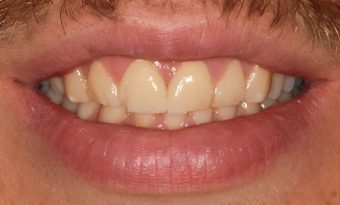 Before - Gibside Dental