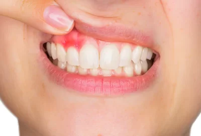 Fix-Heal-Treat-Abscessed-Tooth-Northern-Kentucky-Burlington.webp
